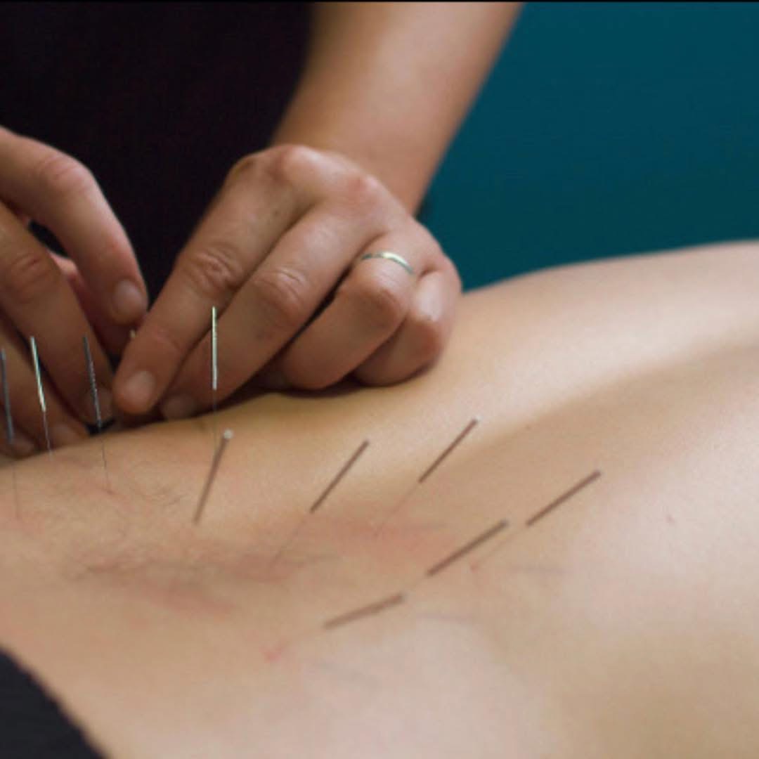 Fine sterile needles being placed into the lower back during dry needling